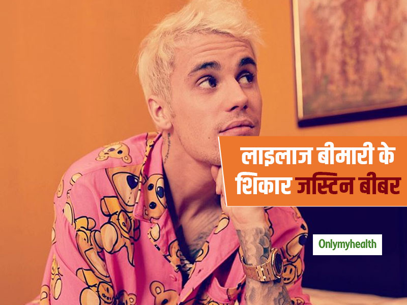 'लाइम डिजीज' नाम की लाइलाज बीमारी का शिकार हुए पॉप स्टार जस्टिन बीबर, जानें इस घातक बीमारी के लक्षण